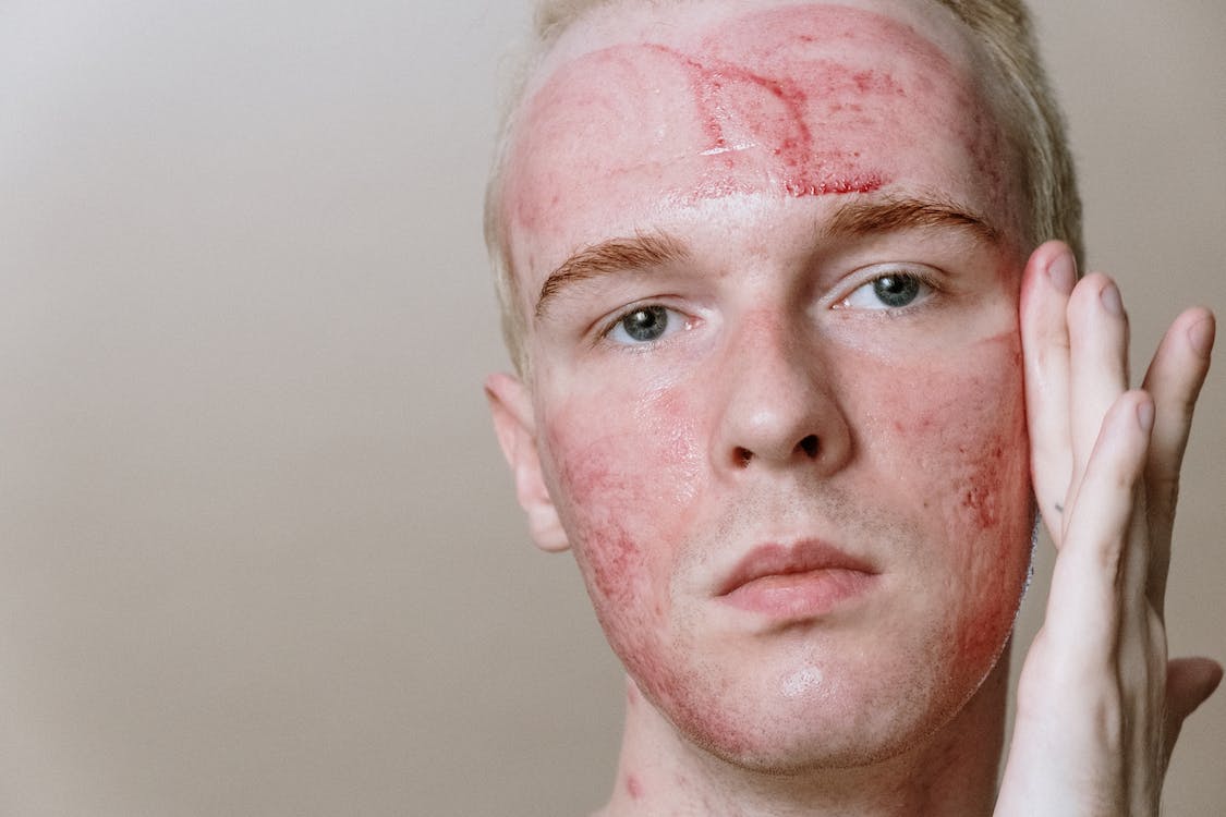 image of man's face with acne